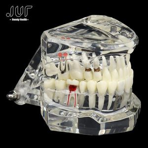 Andere Mundhygiene -Zahnimplantat -Zähnemodell für medizinische Unterrichtsunterricht für Mundgesundheitswissenschaft und Lehrerkrankung Studie 230815