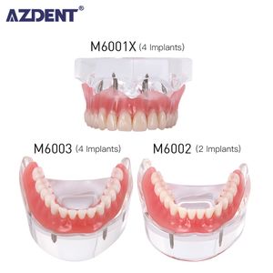 Other Oral Hygiene Dental Implant Restoration Teeth Model Removable Bridge Denture Demo Disease Teeth Model With Restoration Bridge Teaching Study 230425