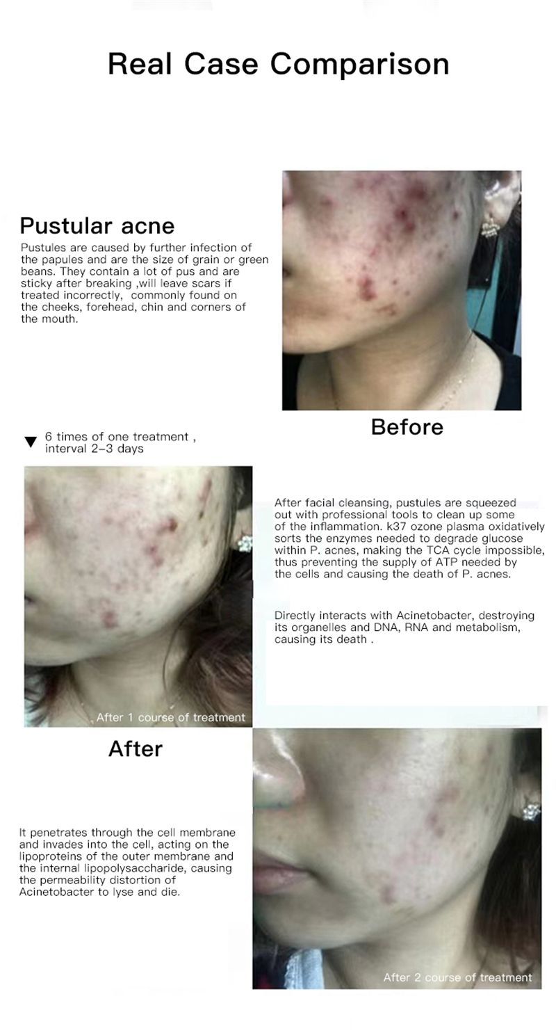 For Mesotherapy Gun Ozone Cold Plasma Pen Blue Light Acne Removal Sensitive Skin Anti Wrinkle Deep Acne Cleaner Eliminating Acne Shrink Pores Beauty