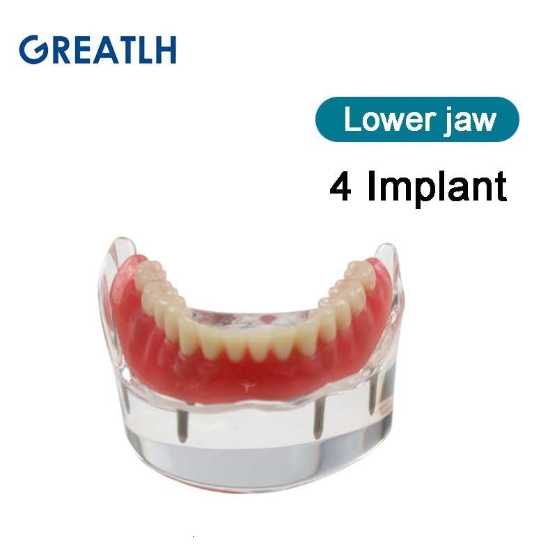 4 implant alt çenesi