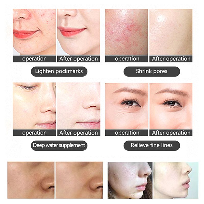 LED Light PDT Therapy Skin Rejuvenation Anti Aging Acne Treatment Photon Therapy Skin Care Beauty Machine