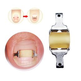 Tool Ingrown Toenail Corrector Tools Pedicure Professional Ingrown Toenail Correction Foot Care Tool Recover Embed Toe Nail Treatment