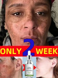 Freckles Removal Essence Remove Facial Spots Skin Dark Spot Remove Melasma Spots Sunspots Whitening And Freckle Removing Cream