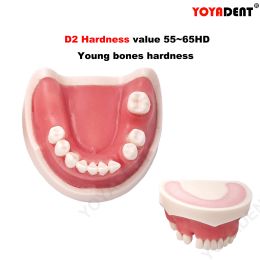 Dental Implant Model Teeth Model For Dentistry Implant Training Gum Sutures Teaching Studying Product Dentist Material