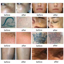 Multifunctional IPL Nd Yag Laser Machine Tattoo Removal RF Skin Rejuvenation 808nm 755nm 1064nm Diode Laser Hair Removal Machine Aesthetic use