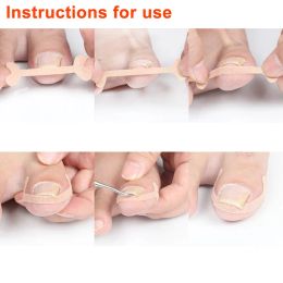20-100Pcs Professional Ingrown Toenail Foot Corrector Stickers Elasticity Nail Care Pedicure Tools Health Care Protects Toe Nail