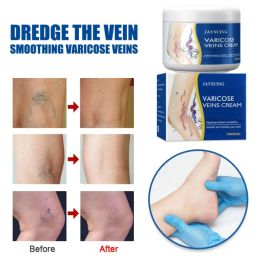 Varicose Veins Cream Vasculitis Phlebitis Remover Spider Veins Pain Varicosity Angiitis Ointment Varicose Veins Treatment