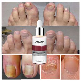 LANBENA Nail Repair Essence Serum Nail Treatment Foot Nail Fungus Removal Gel Anti Paronychia Onychomycosis