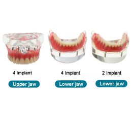 Dentist Teaching Teeth Model Dental Teeth Model with Implant Removeble Bridge Denture Demo Model