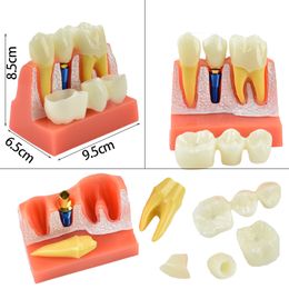 Dental Training Model 4 Times Teeth Implant Analysis Crown Bridge Removable Model for Dentistry Medical Science Teaching Study