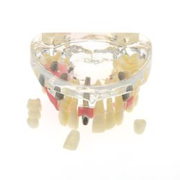 Dental Teeth Model Implant Practice Model With Implant Bridge Caries Teaching Teeth Model For Dentist Implant Treatment Demo