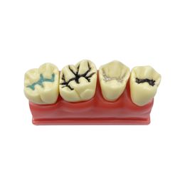 Dental Teeth Model 4 Times Pit And Fissure Sealant Model Pathological Models for Dental Technician Teaching Studying