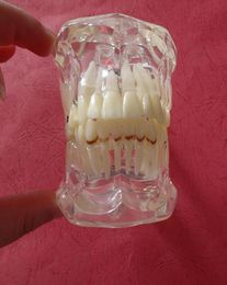 Dental Teeth Pathology Model With Half Implant Show Clearly the Original Shape and the Whole Structure2955674