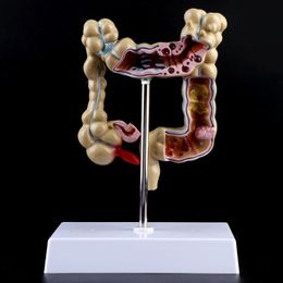 Other Office School Supplies Human Colorectal Lesion Model Pathological Anatomy Colon Diseases Intestine Teaching Learning Tool 230703