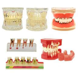 Dental Floss Pathological Typodont Teeth Model PeriodonticsImplantEndodontic Caries dental 230421