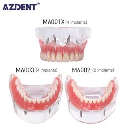 Other Oral Hygiene Dental Implant Removable Denture Demo Disease Teeth Model With Restoration Bridge Teaching Study 230425