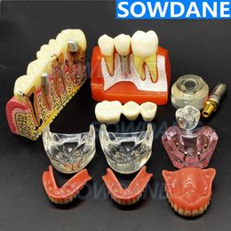 Other Oral Hygiene Dental Implant Demonstration Model Teeth Study Teach Model Disease Analysis with Restoration Crown Bridge Maxillary Mandibular 230609