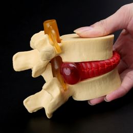 Other Office School Supplies props model Free postage Anatomical Spine Lumbar Disc Herniation Anatomy Teaching Tool 230627
