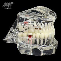 Other Oral Hygiene Dental Implant Disease Teeth Model for Teaching Oral Health Care Science Dental Disease Teaching Study 231010