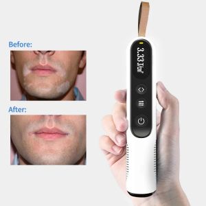 Analyzer HandHeld 308nm UVB Phototherapy Light For Vitiligo Psoriasis White Spot Treatment Lamp Ultraviolet Phototherapy Instrument