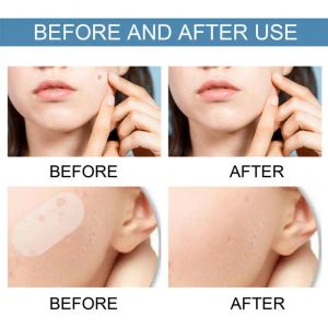 Adesivo invisível de acne pimple hidrocolóides de remoção de acne remendo à prova d'água removedor de cabeça preta Cuidados com a pele facial