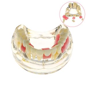 Modelo de dentes dentários com modelo de implante e cárie ensinam o modelo de estudo M2005