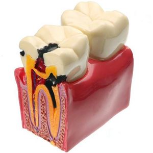 その他の経口衛生1 PC材料ラボの歯モデル6回のcar虫の比較研究モデル230915の研究と研究のための研究モデル