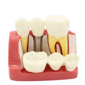 Andere Mundhygiene -Zahnanalyse -Analyse Crown Bridge Abnehmbares Modell Zahndemonstration Zähne Modell 230815