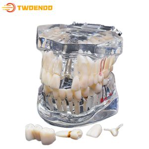 Outro modelo de dentes consumíveis dentários de higiene oral estudando doença de implante com ponte de restauração ensinando 230831