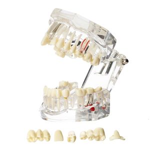 Other Oral Hygiene Dental Model Teeth Implant Restoration Bridge Teaching Study Science Disease Dentist Dentistry Products Dental Gift 230524