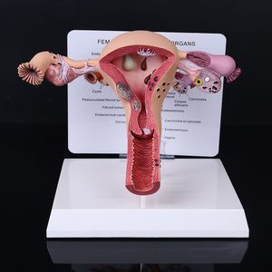 Andere Büro- und Schulmaterialien, hochwertiges menschliches weibliches Uterus-Eierstock-Erkrankungs-Dissektions-Pathologie-Modell, Biologie-Lehrmittel, Anatomie-Läsion, Dropship 230703