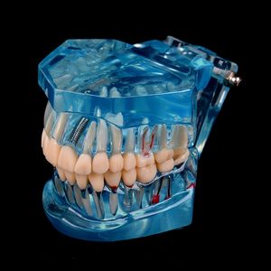 Other Oral Hygiene Dental Implant Disease Teeth Model With Restoration Bridge Tooth Dentist For Science Dental Disease Teaching Study 230720