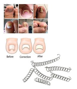 6 pezzi correzione unghie incarnite filo fissatore trattamento pedicure paronichia recuperare strumento per la cura del piede correttore dell'unghia del piede6885102