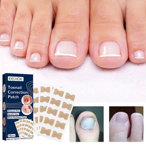 Foot Treatment 50pcs Nail Correction Stickers Ingrown Toenail Corrector Patches Waterproof Paronychia Recover Pedicure Tool 221201
