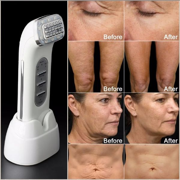 Reale Rimuovere Le Rughe Dot Matrix Radio Frequenza Lifting Viso Lift Corpo Cura Della Pelle Dispositivo di Bellezza 110-240 V 240119