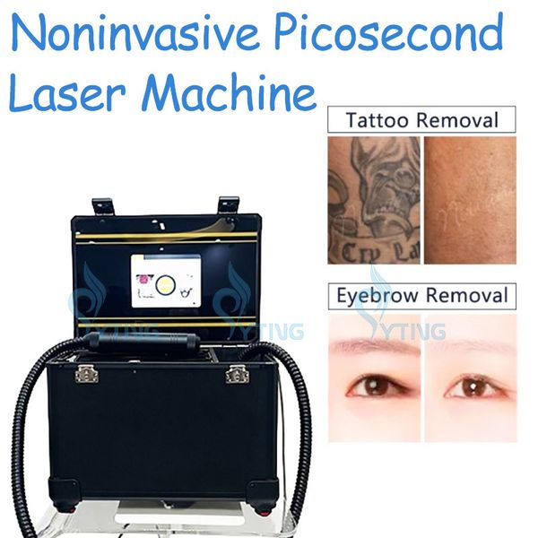 Pikosekunden Nd Yag Laser Pico Second Q Switch Laser Maschine Tattoo Entfernung Sommersprossen Entfernung Pigmentierung Behandlung