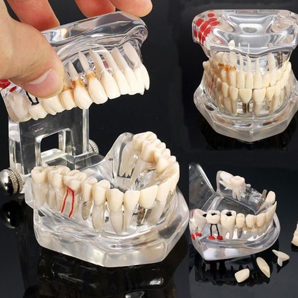 Arti e mestieri Malattia degli impianti dentali Modello dei denti con ponte di restauro Dentista per l'insegnamento delle scienze Study1228l