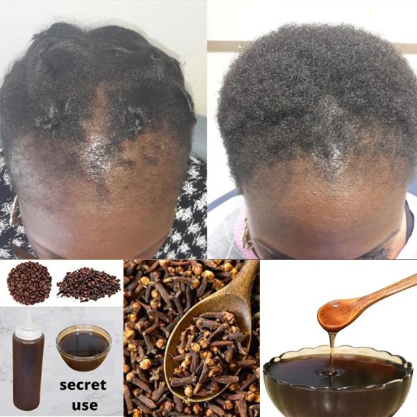 Tratamentos áfrica feminino tração alopecia tratamento produto de crescimento do cabelo para homens chebe pó shampoo tratamento de perda de cabelo livrar-se de perucas