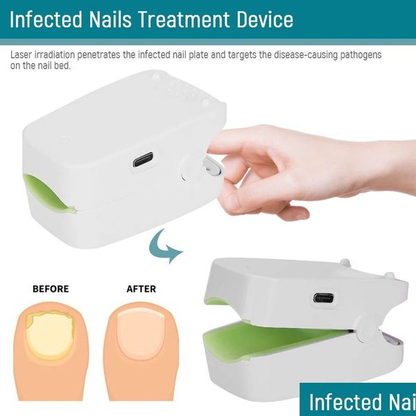 Trattamenti kit per nail art Trattamenti Fungo indolore Dispositivo di terapia laser mini trattamento hine rimozione di infezione terapeutica Ist drop drop.