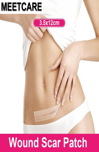 Cicatriz médica afasto patch silicone folha de folha de feridas Remoção de cesariana Seção de cesariana hipertrófica SCARS SCARS TREATEMENTE4641429