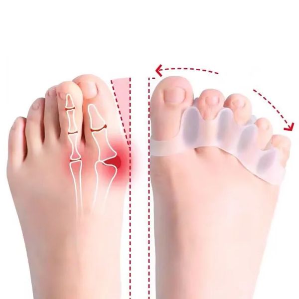 Trattamento 2pc Silicone separatore di punta dita di dita dei piedi spargitore Hallux bunion bogion correttore tamponatore separatori di dito