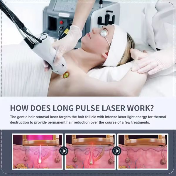 Alexandrite Laser Capelli permanente 1064 755nm Alex Laser Fibra Long Pulse ND YAG Laser Alexandrite e Yag Hair Rimuovi