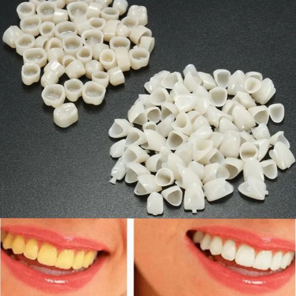 120 Stück Dentalmaterial Zähne gemischte temporäre Krone 70 Stück Anterior-Vorderzahn 50 Stück Molaren-Hinterveneers Zähne Zahnarztwerkzeug 240226