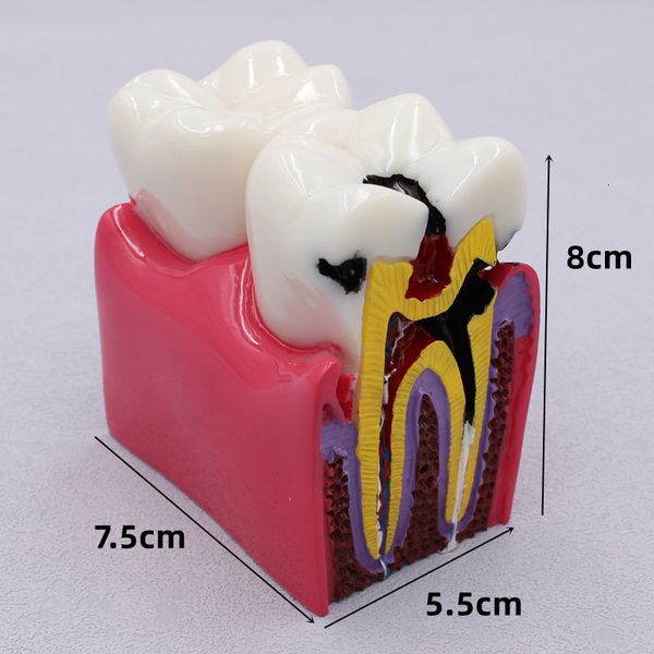 Altro igiene orale 1 PC Materiali dentali Modello di laboratorio 6 volte Modelli di studio di comparazione della carie per lo studio e la ricerca del dentista 230815