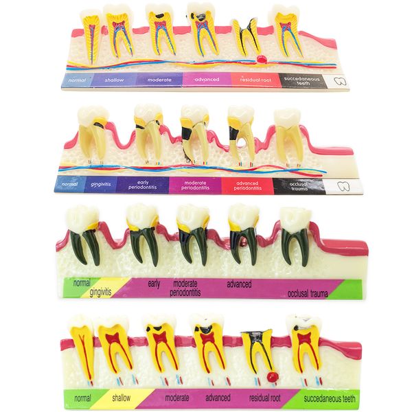 Altro Igiene orale Denti Modello di malattia parodontale Display di rottura della carie dentale Mostra di parodontite Insegnare Modello di dente Dentista Comunicazione 230516