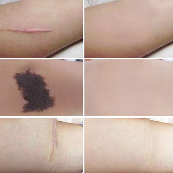 6 stücke Akne Abdeckung Up Aufkleber Sofort Tattoo Narbe Concealer Aufkleber Wasserdicht Fehler Muttermal Verbergen Haut Reparatur Aufkleber