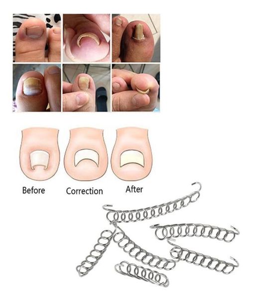 6Pcs Eingewachsene Zehennagel Korrektur Draht Fixer Pediküre Behandlung Paronychie Erholen Zehennagel Corrector Fußpflege Werkzeug6885102