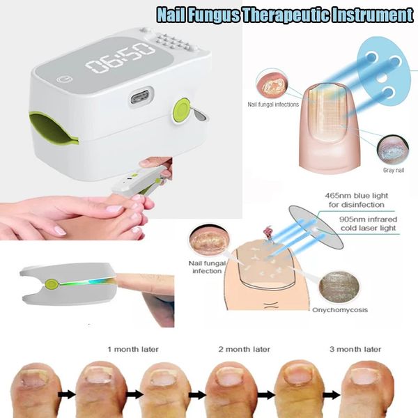 Tratamentos de unhas 905NM Dispositivo de terapia a laser para fungos nas unhas Mini instrumento indolor para fungos nas unhas para cuidados com os pés, clareamento das unhas, remoção de fungos 231108