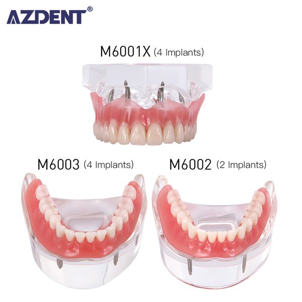 Outros dentes de restauração de implantes dentários de higiene oral Modelo de dentes removíveis Demo de doenças de doenças de doenças de doenças com estudos de ensino de ponte de restauração 230425