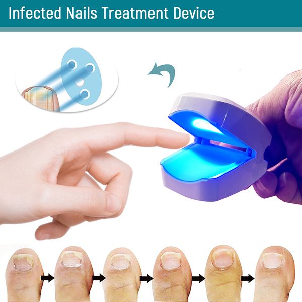 Tratamento para os pés Outros itens de saúde e beleza 905NM Dispositivo para tratamento de unhas a laser para fungos em unhas Terapia de luz Carregamento USB para ferramentas de cura de onicomicose 230602